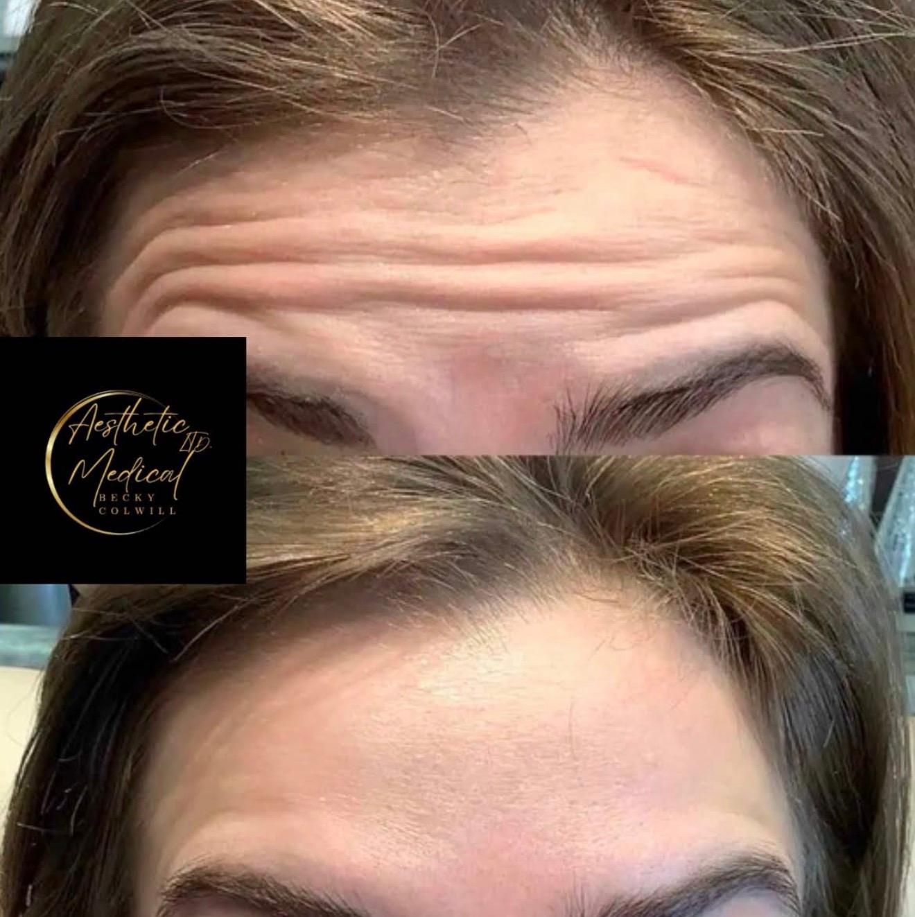Facial Rejuvenation