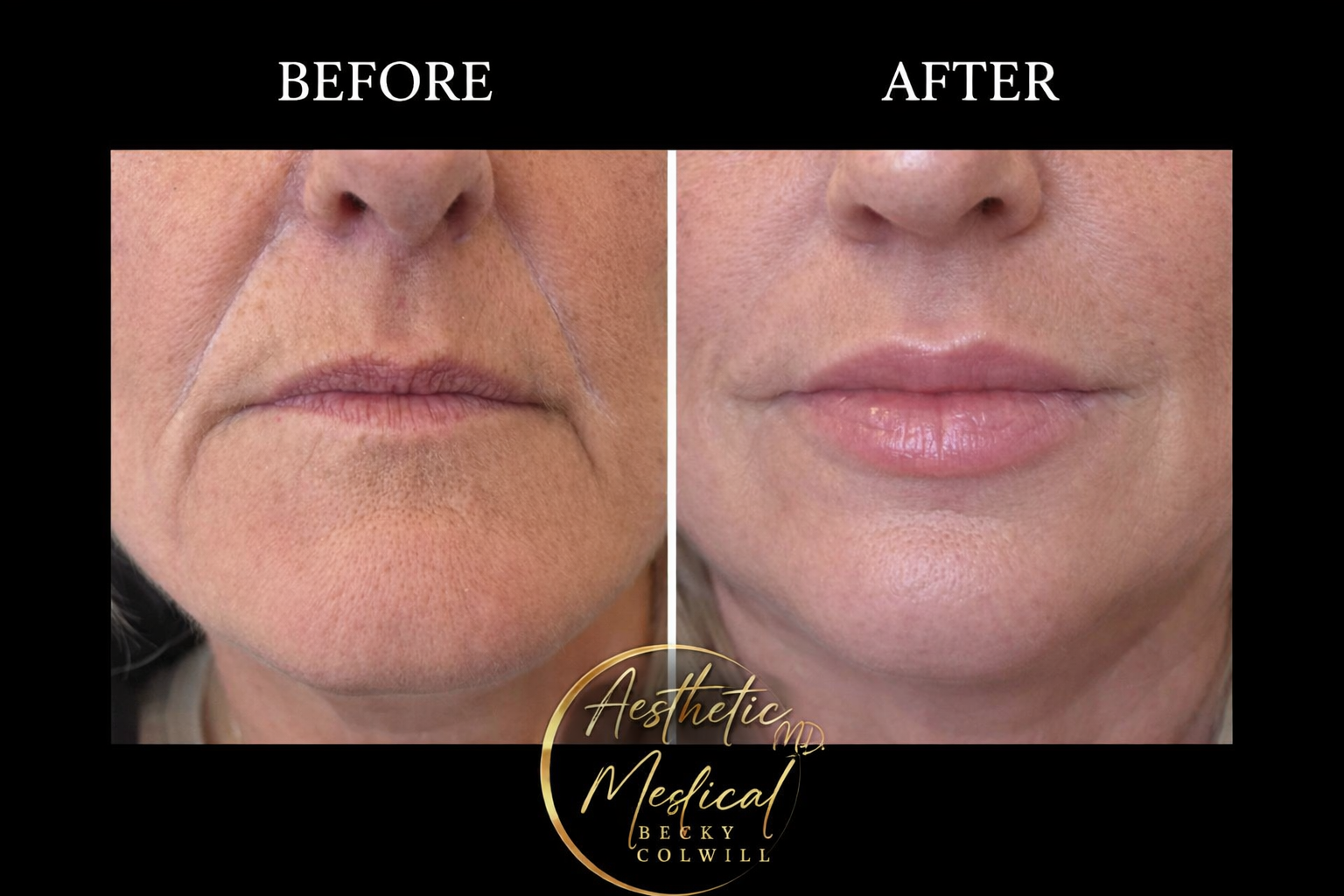 Lip Filler